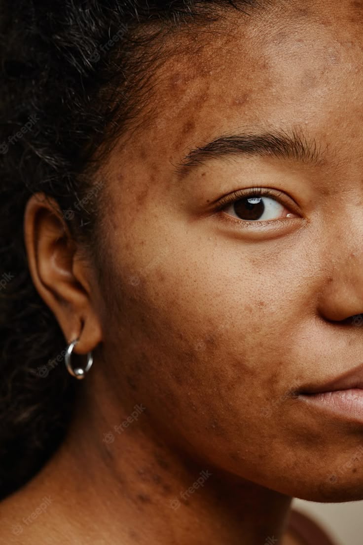 dark-spot-skin