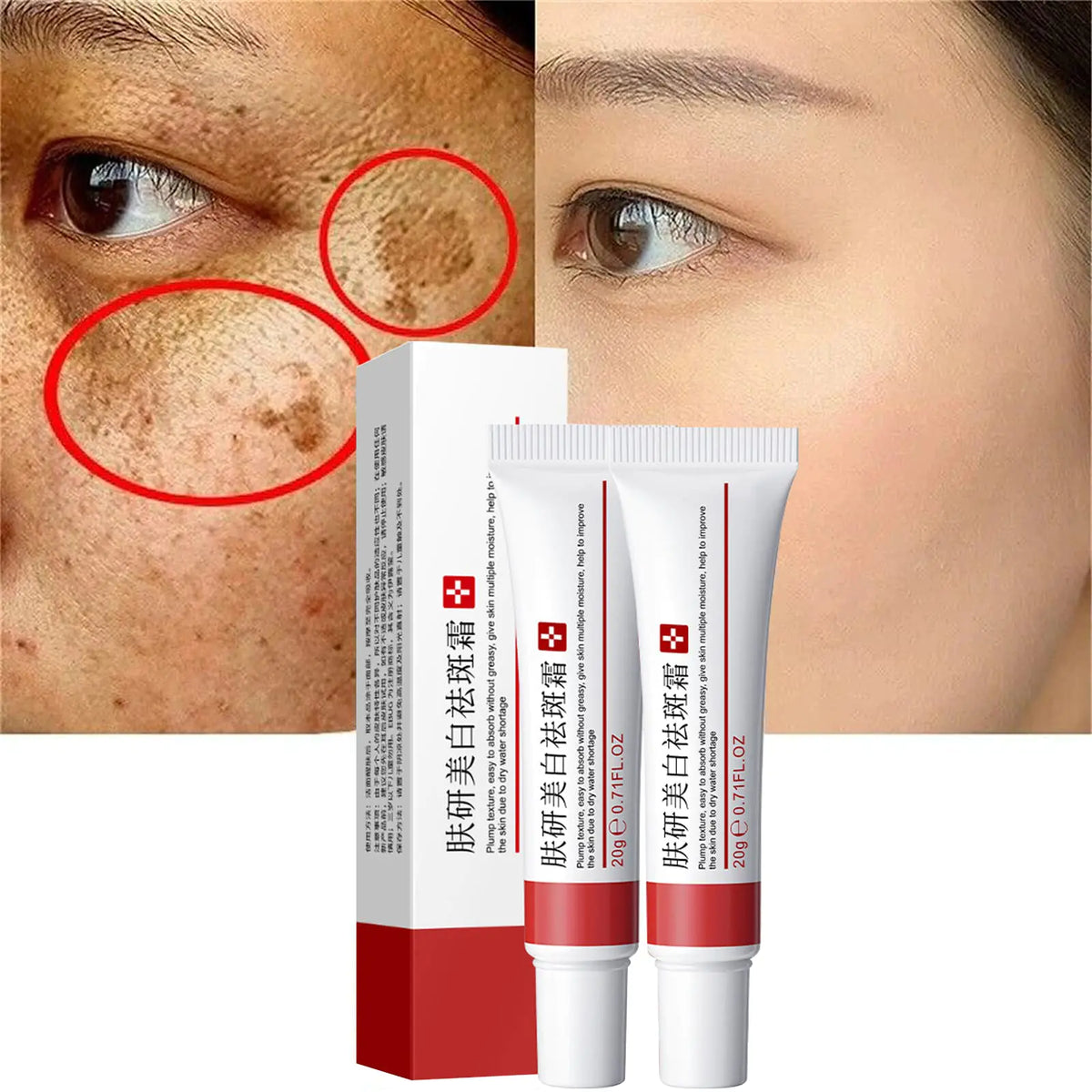 2 Pcs Freckle Cream Acne Scar Removal Treatment Cream Pigmentation Removal Cream for Face Moisturizing Removes Facial Melasma Dark Spots Wrinkles Blemishes (freckle cream)