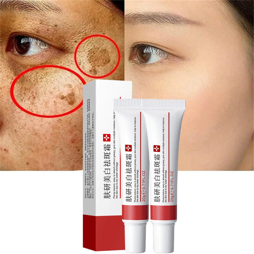2 Pcs Freckle Cream Acne Scar Removal Treatment Cream Pigmentation Removal Cream for Face Moisturizing Removes Facial Melasma Dark Spots Wrinkles Blemishes (freckle cream)